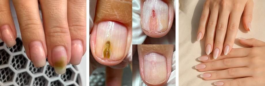 Green bacteria nails